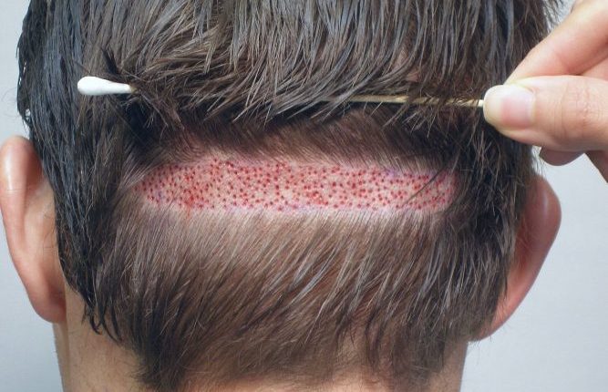 زراعة الشعر بالاقتطاف