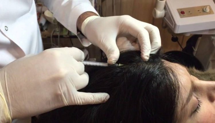 زراعة الشعر بحقن البلازما